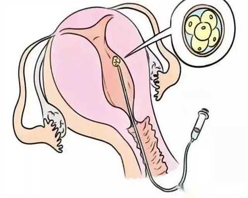 患有干燥综合症在深圳做试管婴儿的流程是怎样的？